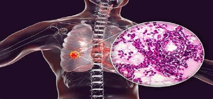 Akeso's Cadonilimab Receives Second Indication Approval from NMPA