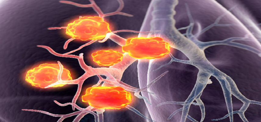Dizal Seeks US FDA Approval for Sunvozertinib to Treat Relapsed or Refractory NSCLC