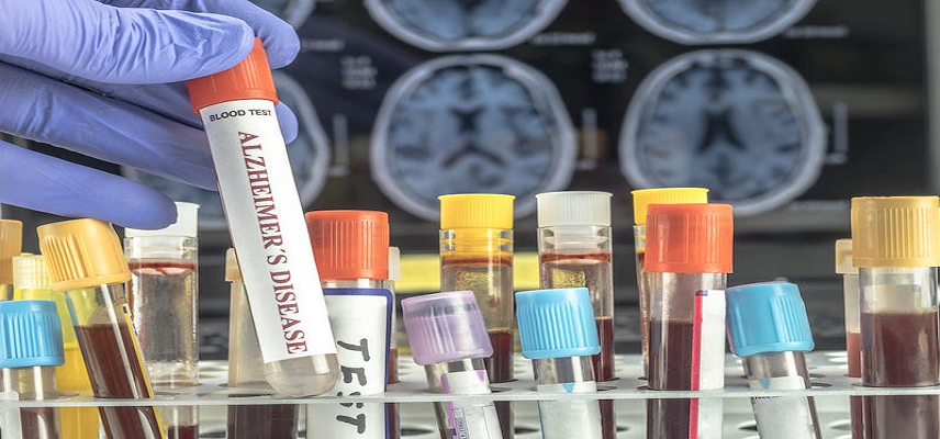 Roche Unveils New Alzheimer’s Resea..
