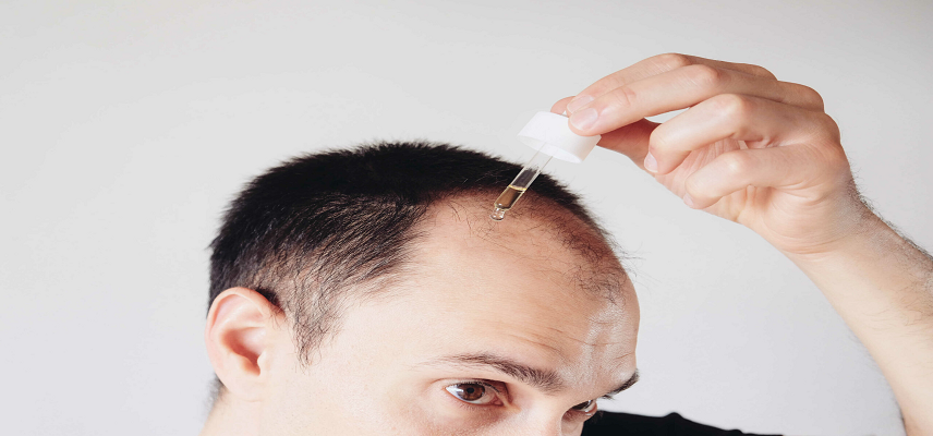 Sublingual Minoxidil Enters Phase 3..