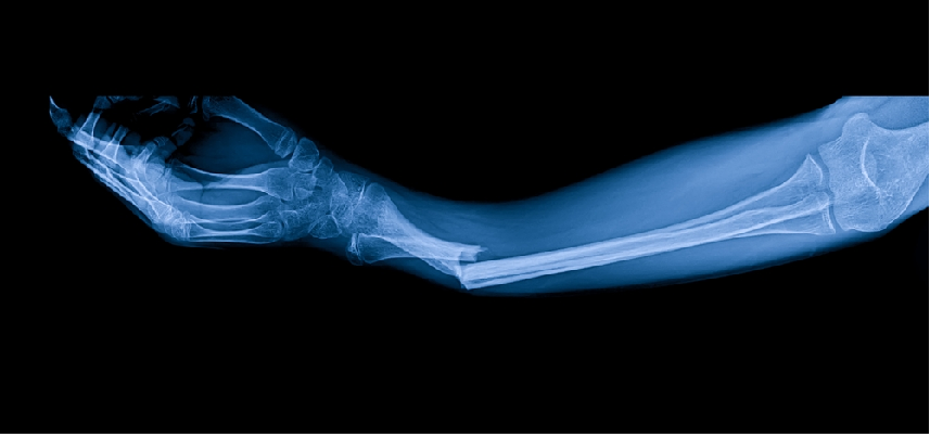 Ultragenyx’s Setrusumab Misses Prim..