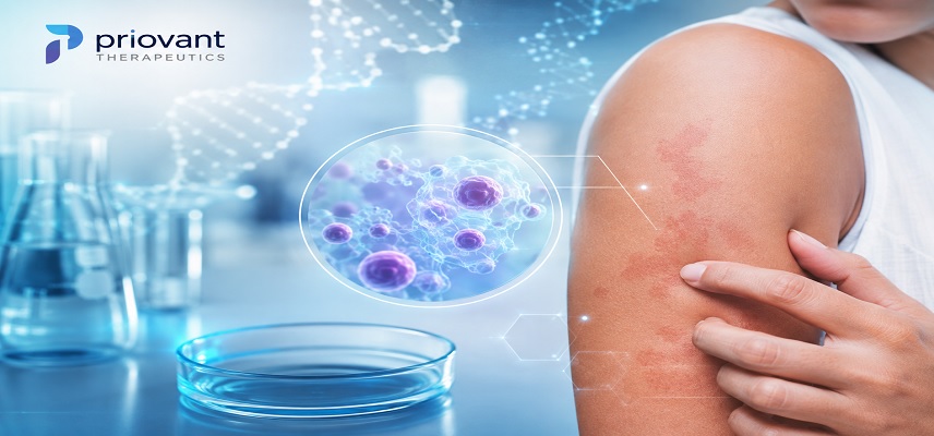 Priovant Starts Phase 3 Study of Br..